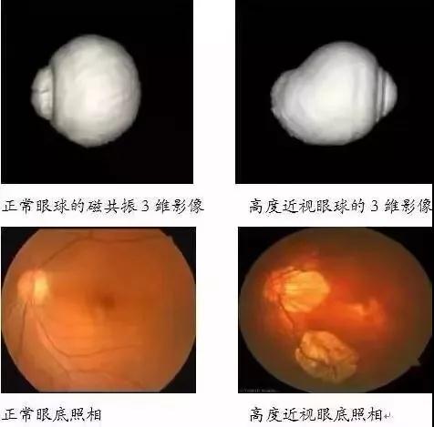 高度近视的人能做剧烈运动吗?